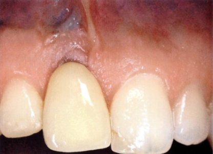 Khi nào cần ghép mô mềm quanh implant?