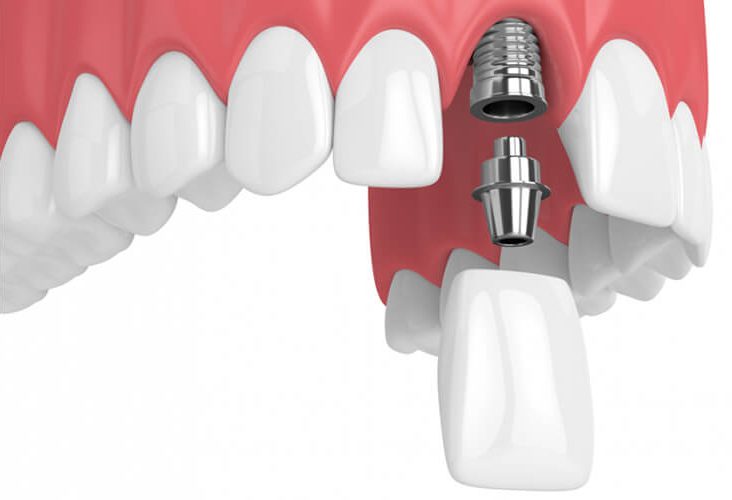 Trồng 1 răng Implant hết bao nhiêu tiền?