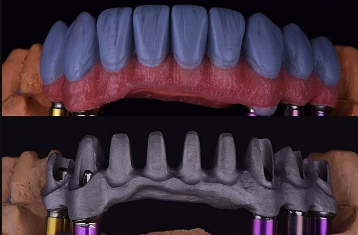 Cầu Marlon là gì? Giải pháp phục hình tối ưu sau cấy implant toàn hàm