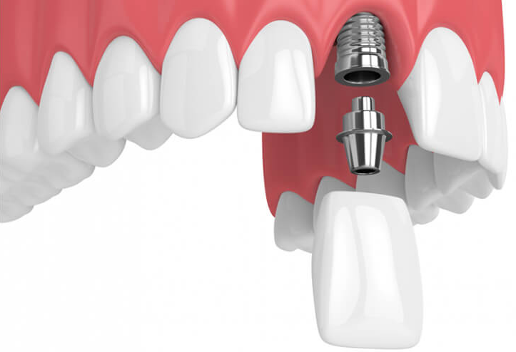 [Giải đáp chuyên sâu] Mỗi vị trí mất răng nên chọn loại trụ Implant nào?
