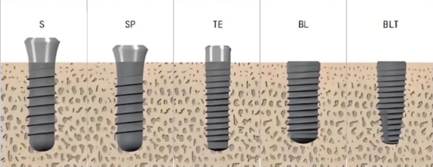 Phân loại trụ Straumann (ITI): Các dòng trụ implant và chỉ định phù hợp
