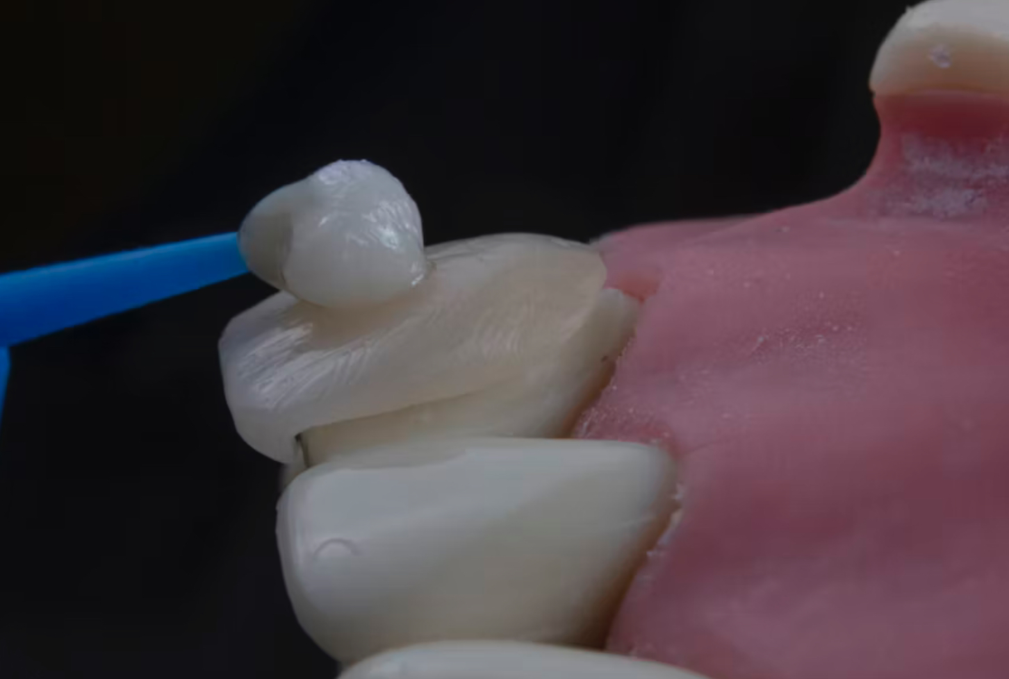 Những câu hỏi thường gặp khi làm răng sứ thẩm mỹ toàn hàm – Giải đáp từ bác sĩ