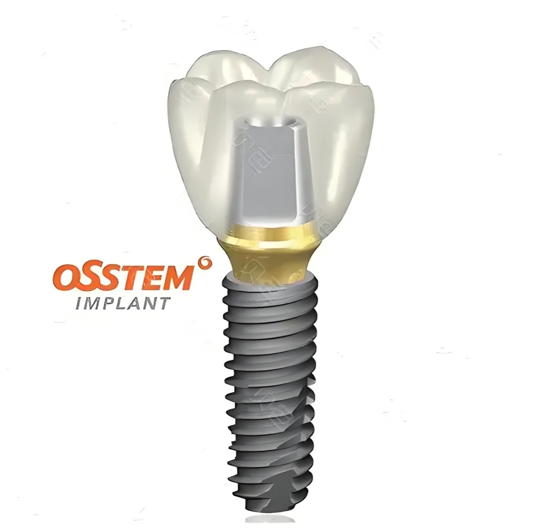 Implant Osstem (Hàn Quốc) có tốt không? Phân tích chuyên sâu từ góc nhìn lâm sàng
